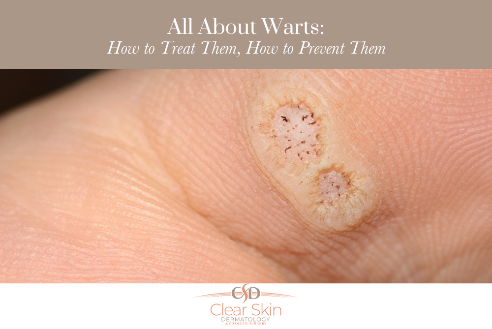 All About Warts How to Treat Them, How to Prevent Them
