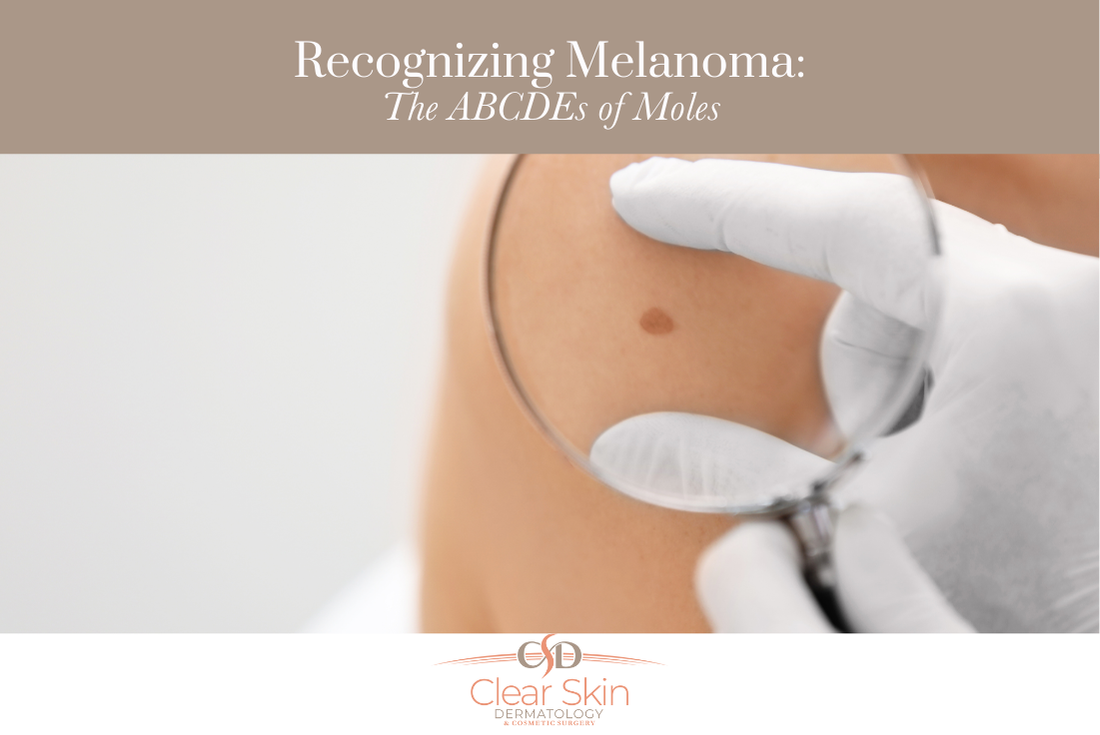 Recognizing Melanoma The ABCDEs of Moles