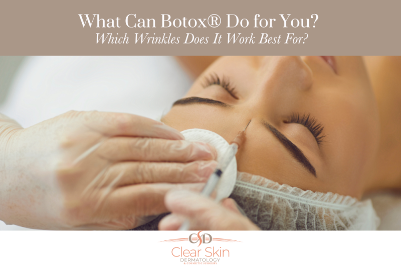 What Can Botox Do for You Which Wrinkles Does It Work Best For