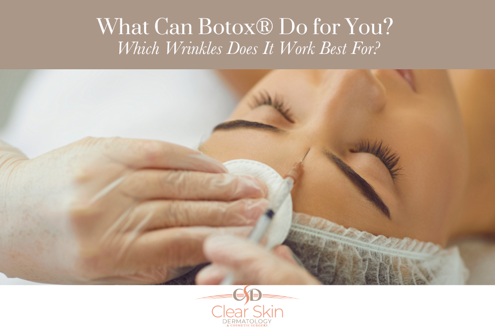 What Can Botox Do for You Which Wrinkles Does It Work Best For