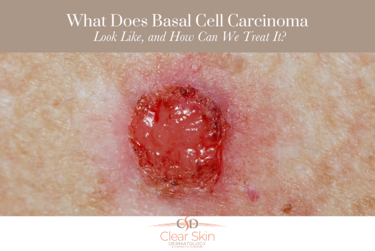 What Does Basal Cell Carcinoma Look Like, and How Can We Treat It ...