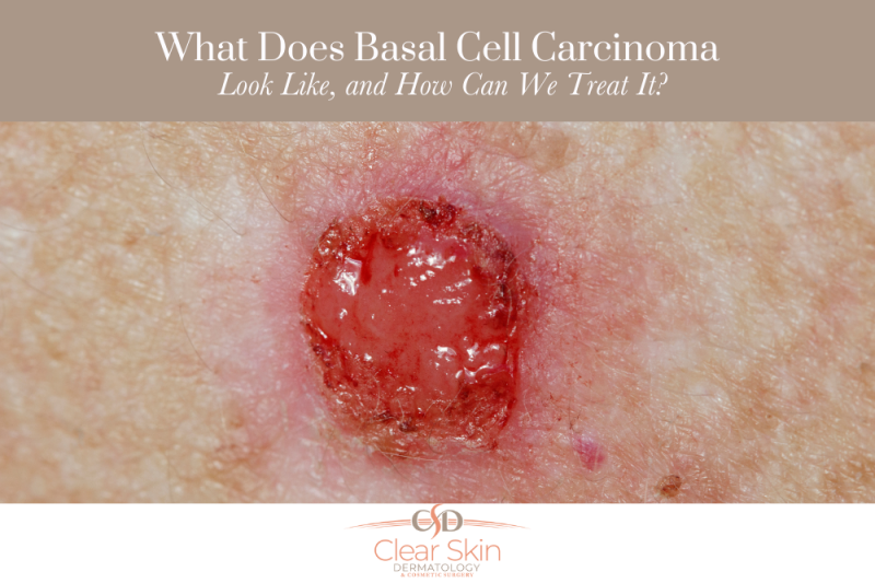 What Does Basal Cell Carcinoma Look Like, and How Can We Treat It
