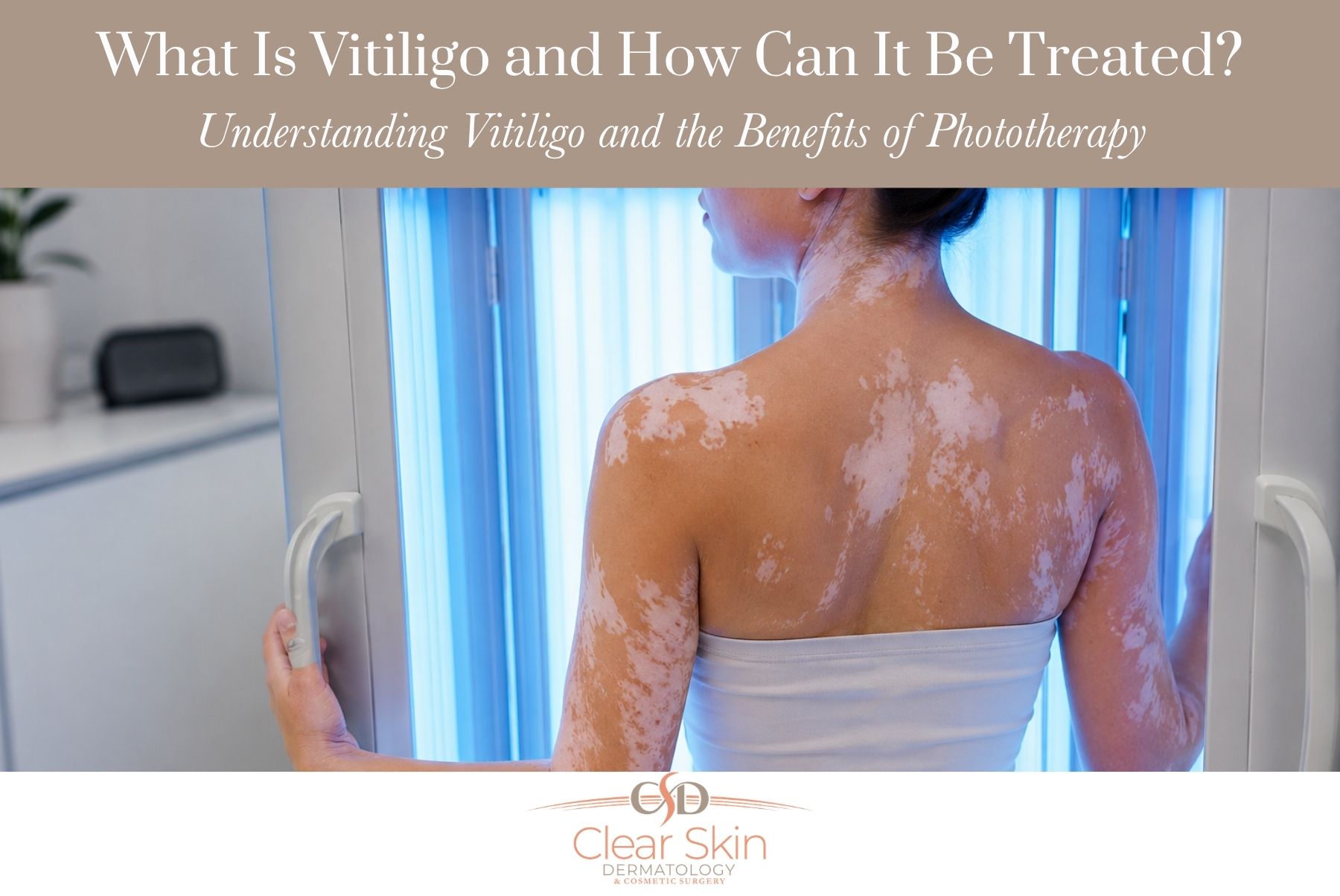 What Is Vitiligo and How Can It Be Treated?
